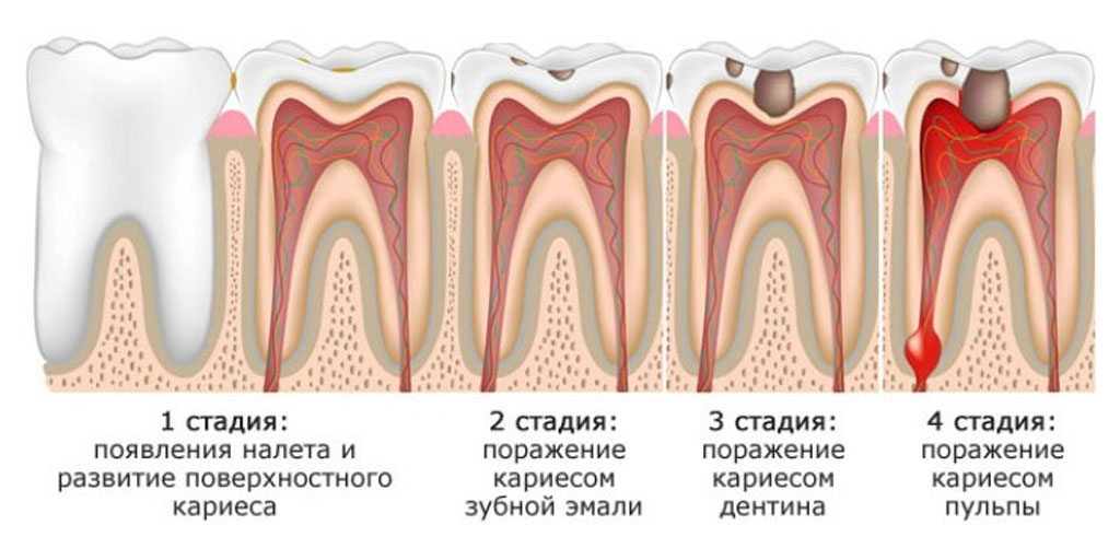 пульпит зубов
