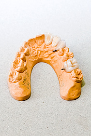 Центральная группа зубов. Изготовление безметалловой керамики VM-7. VM-9