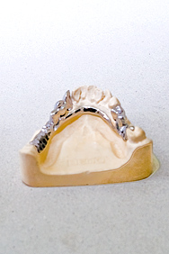 Конструкция бюгельного протеза на нижнюю челюсть с опорными элементами аттачменами Анкора